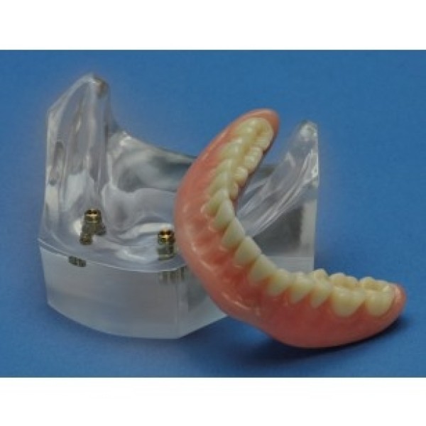 ESP Model Dental Implant Overdenture Model with Two Locator Inserts (ZDM-009-OM)