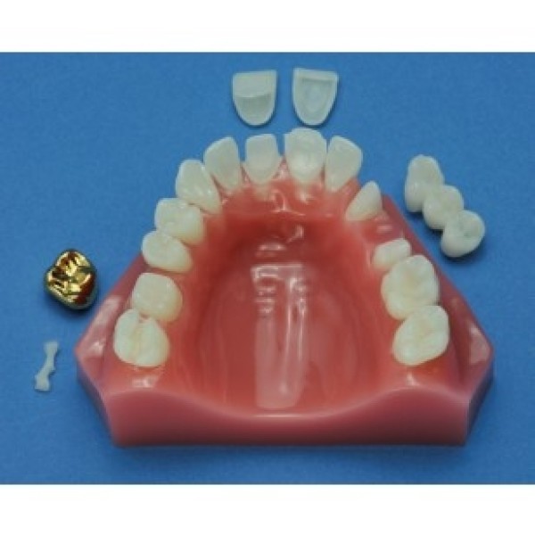 ESP Model Cosmetic Dentistry Maxilla 6-Part (ZDM-011-CD)