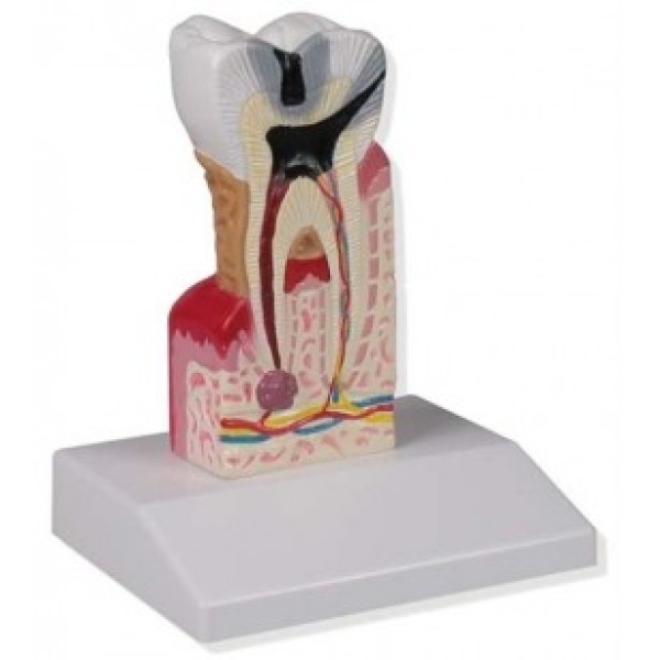 ESP Model Dental Caries, 10X Life Size (ZKH-854-D)